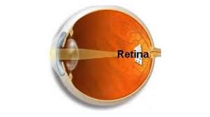 Descolamento de Retina