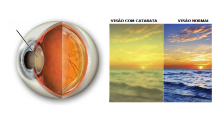 Catarata
